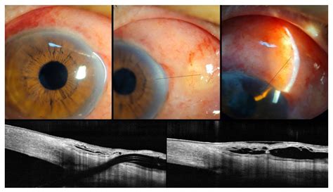 Management of XEN Gel Stent Exposure with Conjunctival Erosion via ...
