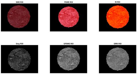 Machine Learning Model Development for Malignant Prostate Lesion ...