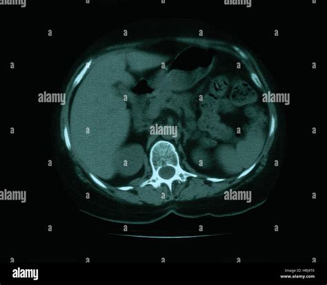 Lung ct scan hi-res stock photography and images - Alamy