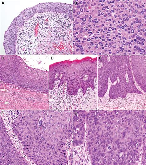 Clinicopathological Characteristics of High-grade Squamous ...