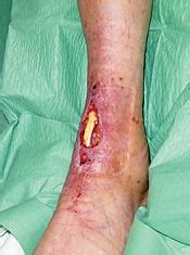 Higher infection rate found with ankle arthroplasty compared to total ...