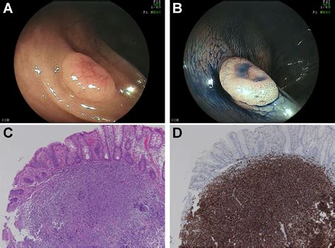 Mucosa Associated Lymphoid Tissue