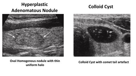 Thyroid Ultrasound and TIRADS | PPTX