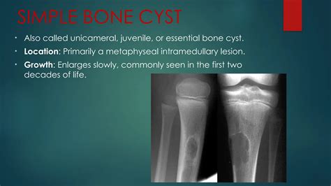 Bone tumors-fibrous dysplasia,simple bone cyst,aneurysmal bone cyst | PPT