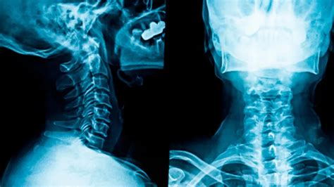"Understanding Neck X-Ray: What You Need to Know" | Scarborough ...