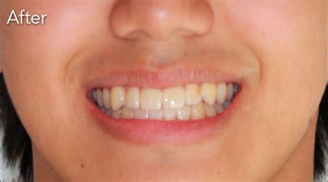 Invisalign in Gurgaon | Invisible Braces Treatment Cost in Gurgaon