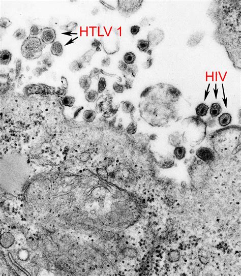 Electron micrograph of HTLV-1 and HIV | Biology of Human/World of Viruses