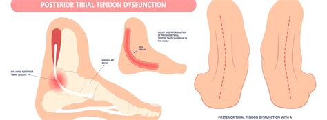 Tibialis Posterior Tendon Dysfunction | Matthew Appleton