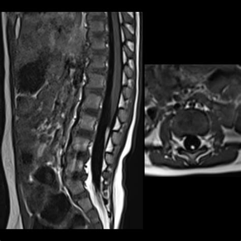 Toddler with a sacral dimple | Pediatric Radiology Case | Pediatric Imaging | @pedsimaging ...