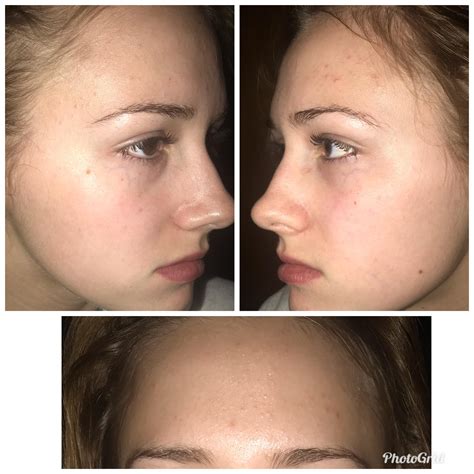 [acne] How can I get rid of these tiny bumps on my forehead? : r/SkincareAddiction