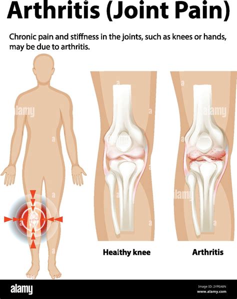 Illustration of arthritis affecting knee joints Stock Vector Image & Art - Alamy