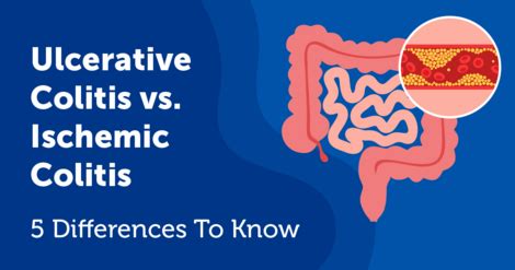 Colitis Vs. Cancer 的图像结果