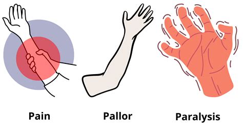 Compartment syndrome and Volkmann’s ischemic contracture: the real emergency of a swollen limb