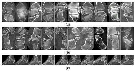 Real-Time Automated Segmentation and Classification of Calcaneal ...