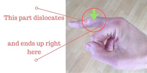 Image result for Finger Dislocation Reduction