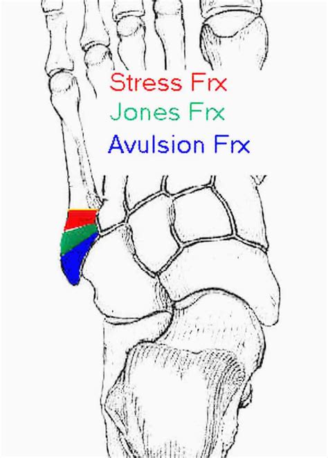 Pseudo Jones Fracture