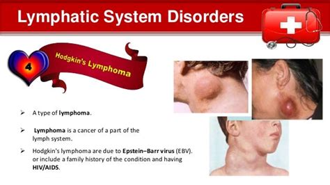 Image result for Lymphatic System Disorders