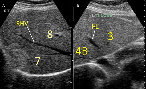 Liver Ultrasound Anatomy