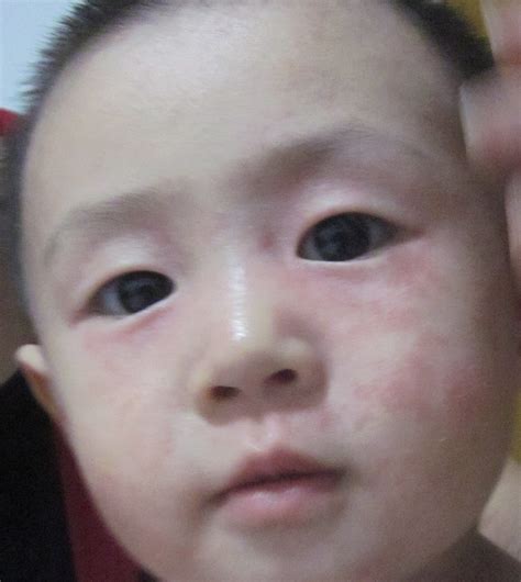 宝宝脸上有很多小红点，并且很痒，(有图）用湿疹膏等等药涂了没用 - 百度宝宝知道