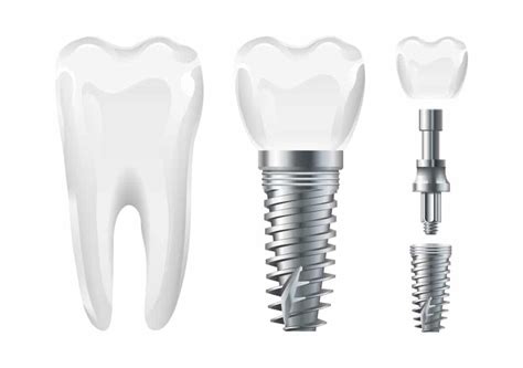 Image result for Different Types of Teeth Implants