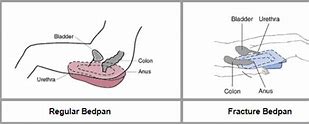 Image result for Fracture Bedpan
