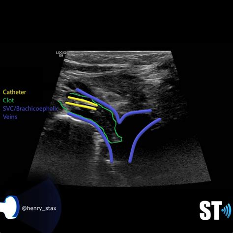 Venous Doppler Ultrasound