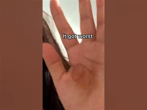 Exploding Cysts Compilation 的图像结果