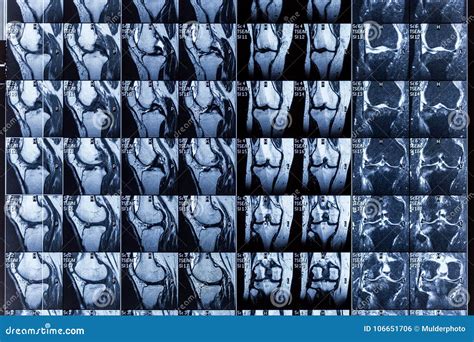 Magnetic Resonance Imaging MRI of Human Knee Joint for Medical Diagnosis Stock Photo - Image of ...