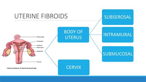 Fibroid uterus | PDF