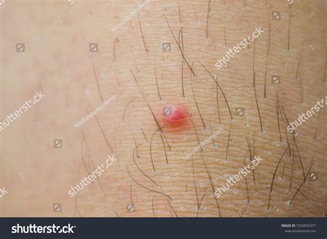 Image result for Hair Splinter Infection