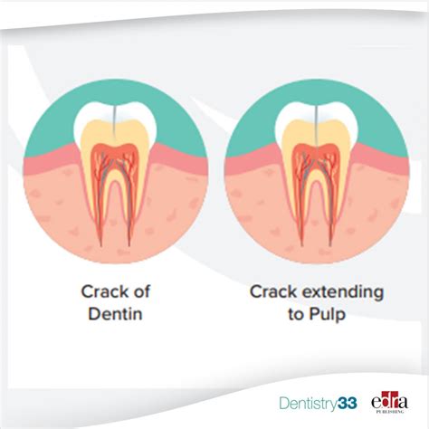 FDI guidance on the treatment of cracked tooth syndrome | Dentistry33