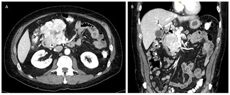 Contemporary Approaches to the Surgical Management of Pancreatic ...