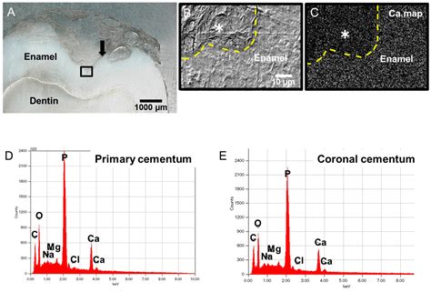 Coronal Cementum and Reduced Enamel Epithelium on Occlusal Surface of ...