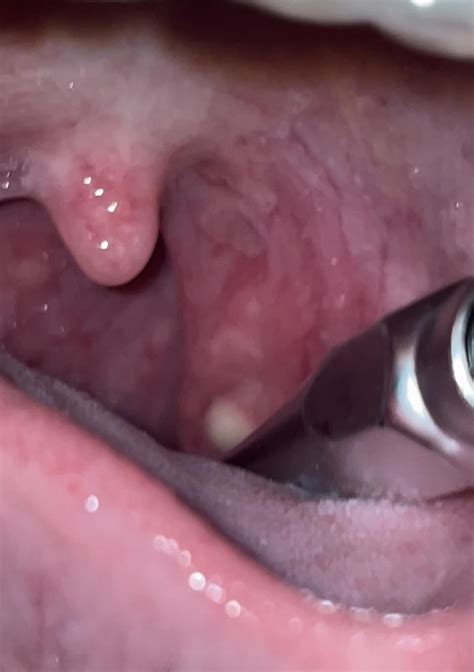 Cysts On Tonsils