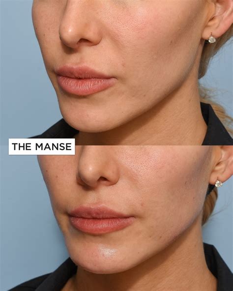 Jawline Dermal Filler - Best Clinic Sydney for Dermal Fillers