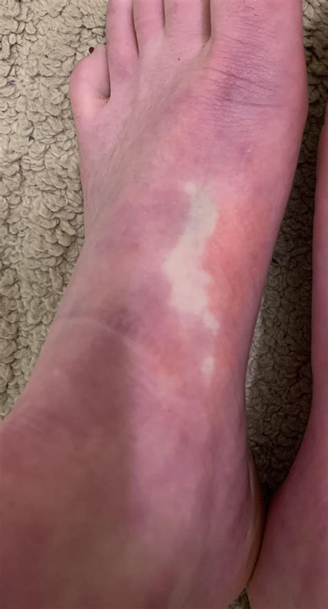 Why do my feet turn purple and look like this randomly? : r/DiagnoseMe