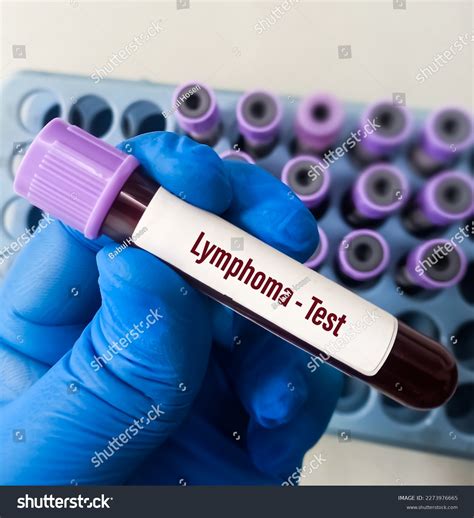 Blood Sample Lymphoma Test Hodgkin Lymphoma Stock Photo 2273976665 | Shutterstock