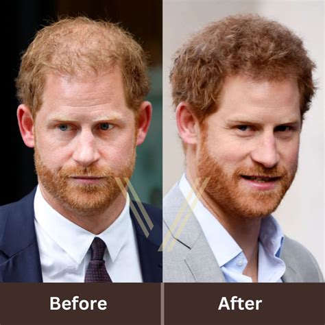 Prince Harry Hair Transplant: Before and After Transformation