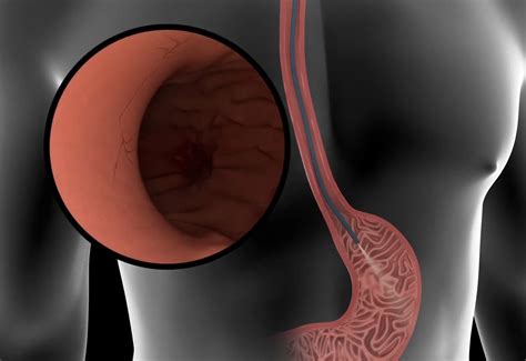 منظار المعدة - عيادات انسان | لأمراض الجهاز الهضمي والكبد والمناظير