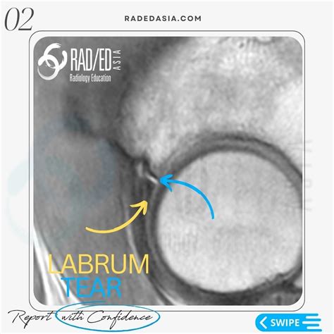 HIP LABRUM LABRAL TEAR MRI RADIOLOGY - Radiology Education Asia