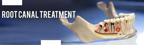 Root Canal Treatment | Dentora Dental Care, Ramanathapuram