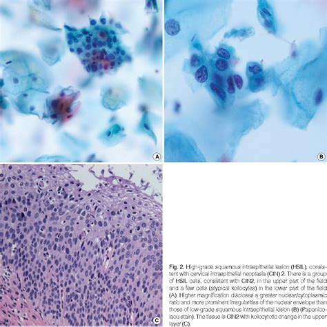 Table 1 from Evaluation of Low-Grade Squamous Intraepithelial Lesions, Cannot Exclude High-Grade ...