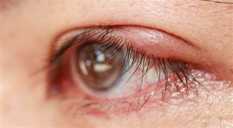 Bildergebnis für blepharitis symptome