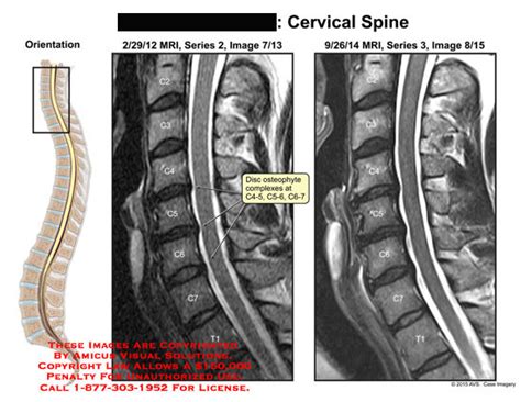 AMICUS Illustration of amicus,injury,mri,disc,osteophyte,complexes,c2 ...