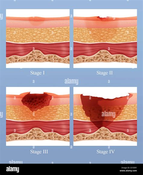 Bed Sores: Why They Develop, How They Manifest And Heal – Estrich Mobil