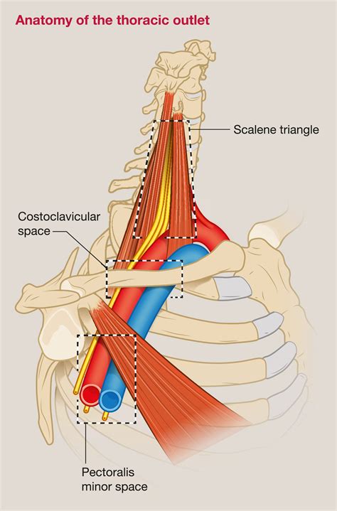 Thoracic outlet syndrome - Surgery - Oxford International Edition