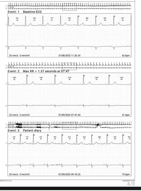 Does this EKG so left and/or right atrial enlargement? : r/askCardiology