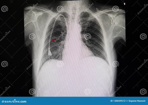 Double Lumen Catheter and a Chest Film Stock Photo - Image of condition, contrast: 130039512