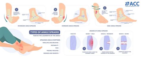Ankle pain - ACC
