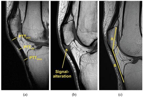 MRI Characteristics and Alterations in Patellar Height in Patients with ...